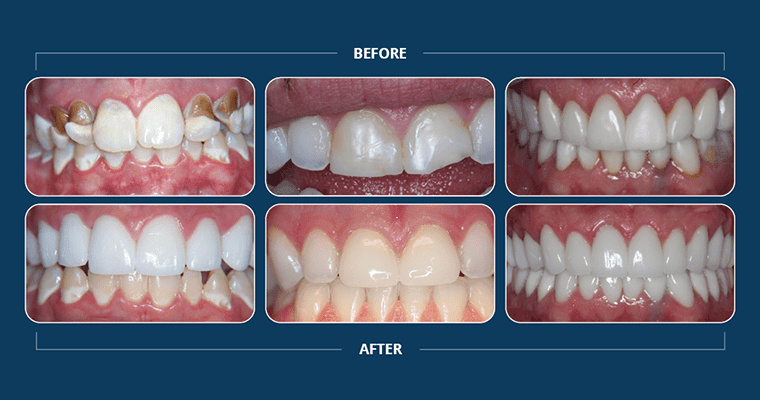 3 before and after cosmetic dentistry cases showing to to fix your smile.
