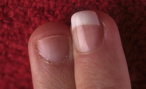 This nail biter's finger is transformed. The shape of the finished nail draws attention away from the puffiness, and the length, which goes just to the tip of the finger, is ideal. Any longer than this would probably result in service breakdown